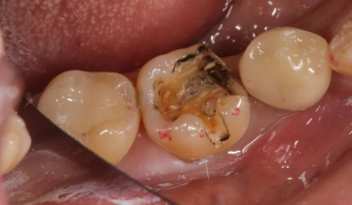 3:歯を削る 3:歯を削る