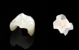 オールセラミック
プレスセラミック