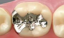 メタルインレー